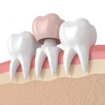 Коронки на зубы в Малоярославце. Ортопедическая стоматология