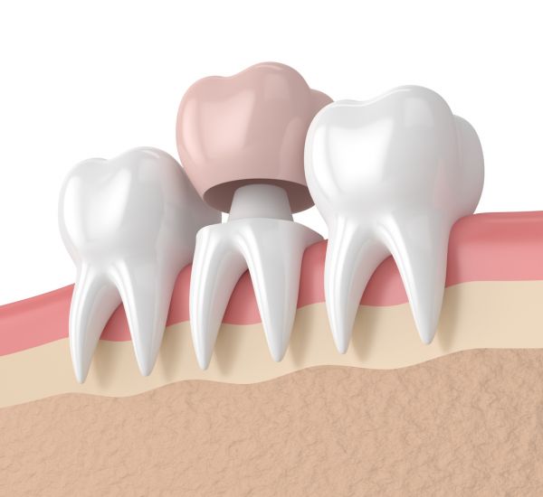 Коронки на зубы в Малоярославце. Ортопедическая стоматология